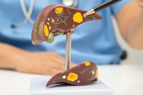 Liver Transplant