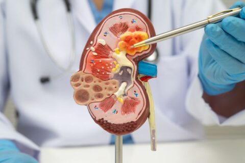 Kidney Transplant